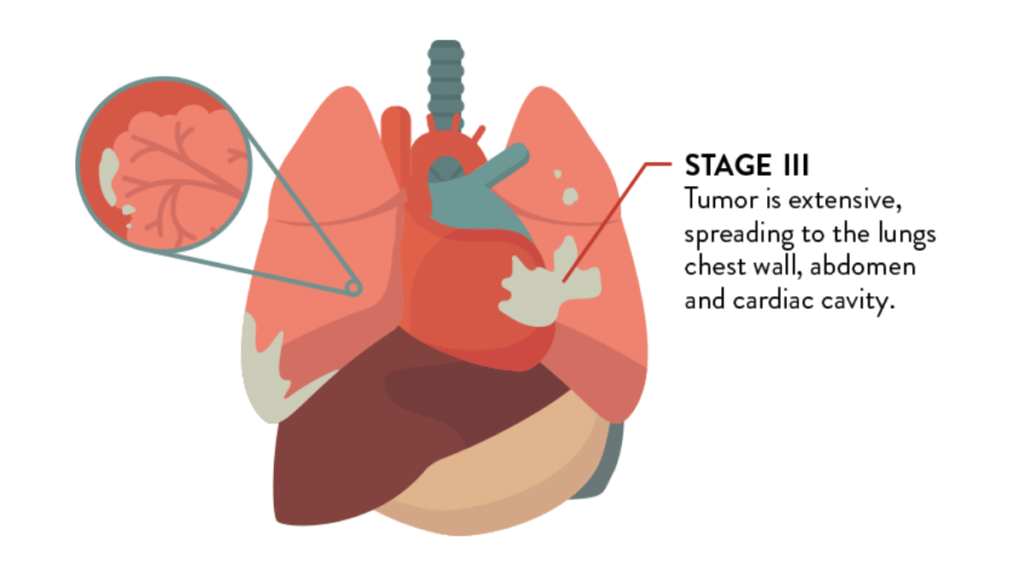 Stage 3 Mesothelioma