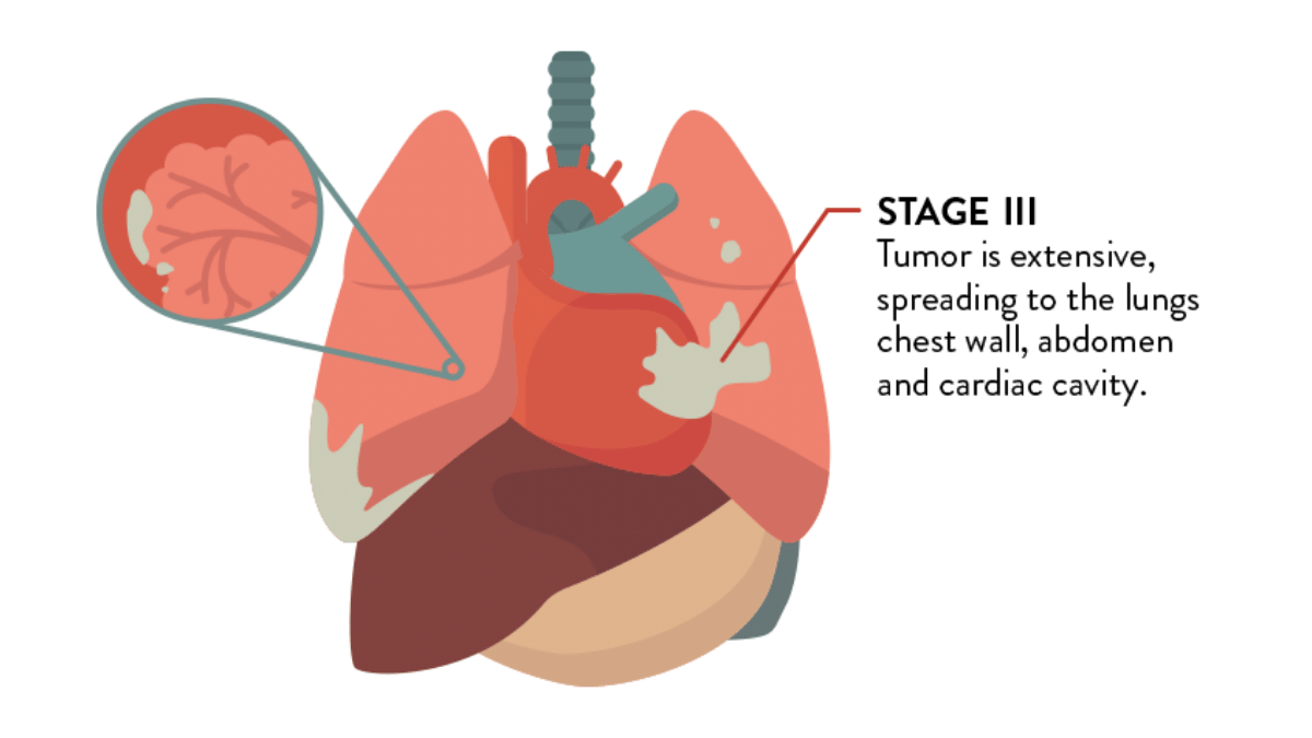 Stages of cancer. Mesothelioma lawsuit.